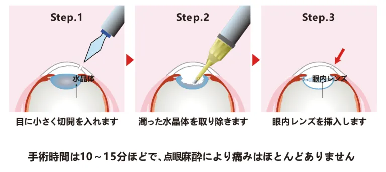 手術方法